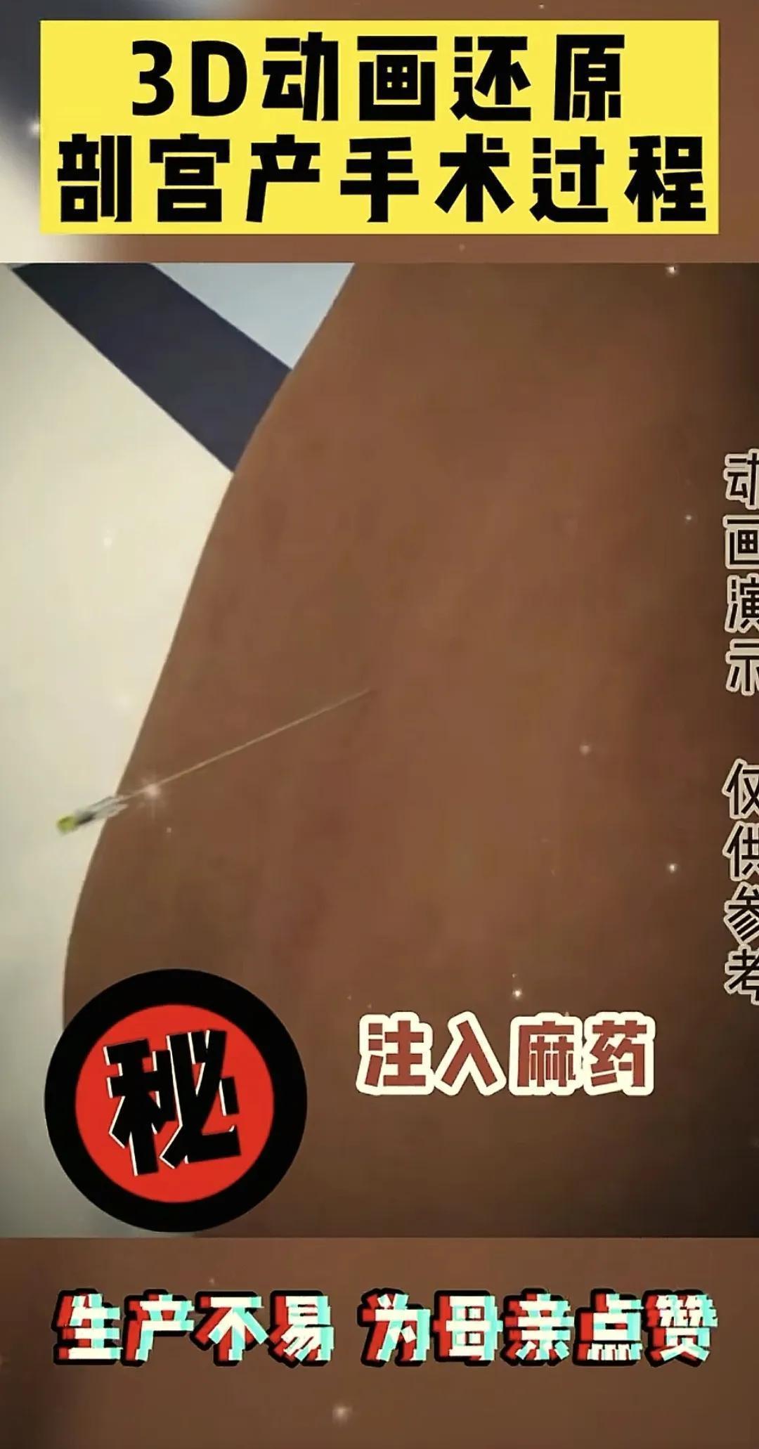  「医学科普·技术解密」：剖腹产手术全流程技术拆解——那些被忽视的医学真相 健康养生