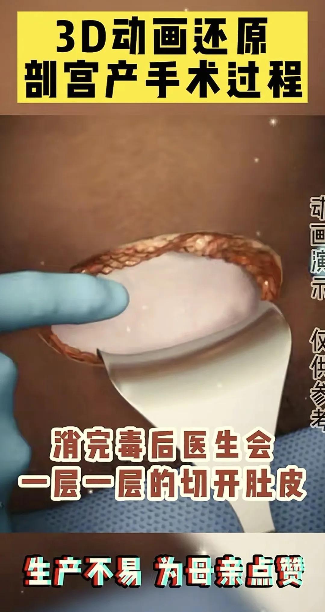  「医学科普·技术解密」：剖腹产手术全流程技术拆解——那些被忽视的医学真相 健康养生