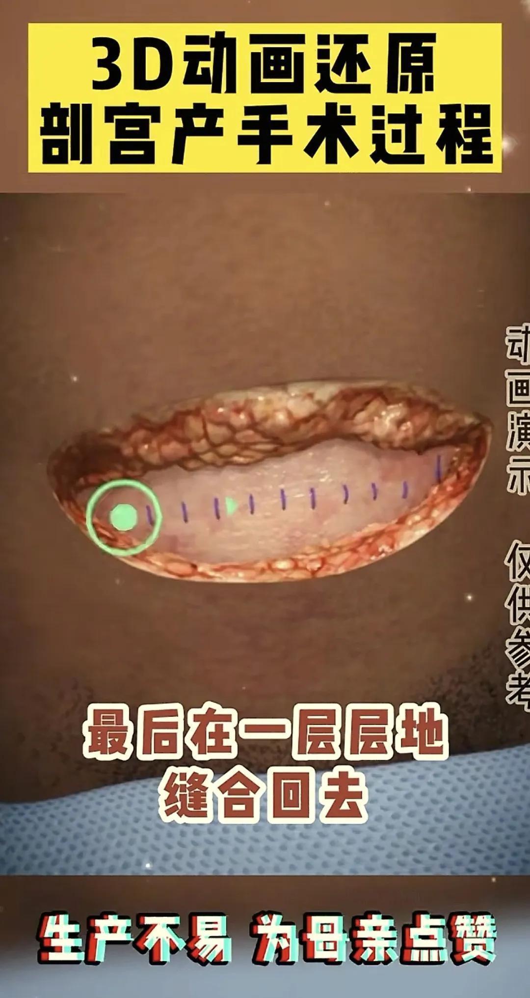  「医学科普·技术解密」：剖腹产手术全流程技术拆解——那些被忽视的医学真相 健康养生